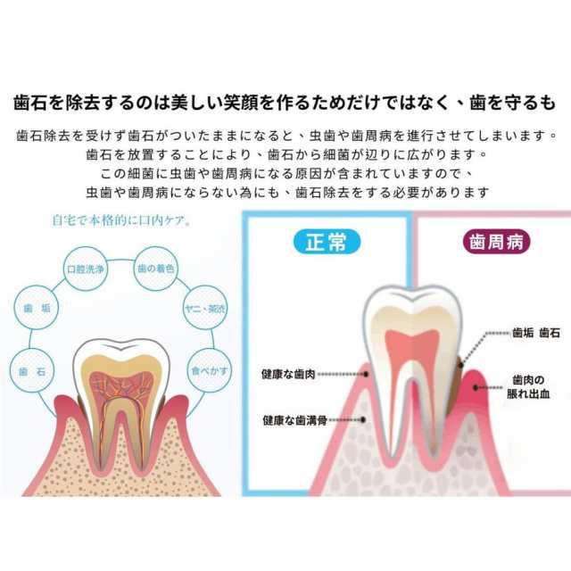 IPX6防水 歯石取り 超音波 超音波スケーラー 歯用ツール 電動 歯クリーナー 歯石歯垢とり 器具 自分で 電動歯ブラシ 口腔洗浄器  歯石除去の通販はau PAY マーケット - 電子部品商店 au PAY マーケット店 | au PAY マーケット－通販サイト